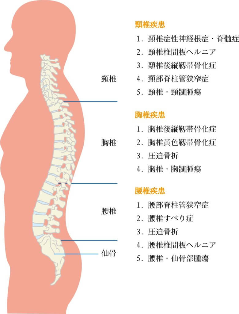Spinal-disease-illustration